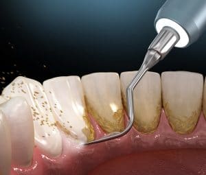 Oral hygiene: Ultrasonic teeth cleaning machine removing calculus and plaque. Medically accurate 3D illustration of human teeth treatment