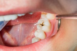 Cavity-Free for Life: The Benefits of Dental Fillings