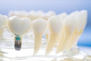 implant and orthodontic model for student to learning teaching model showing teeth.