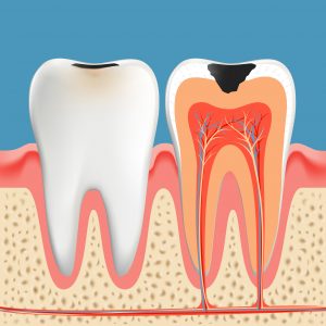 Tooth decay anatomy poster.  Enamel and dentin of teeth caries Infection. Vector illustration