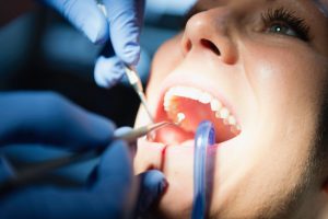 Dentist doing dental filling tooth in dentist office