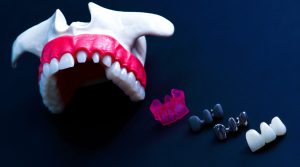 Teeth implant and crown installation process isolated on a blue background. Medically accurate 3D illustration