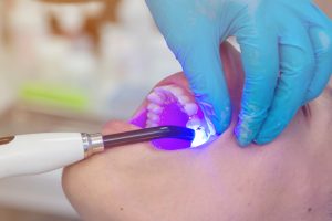 Dentist working with dental polymerization Lamp in oral cavity.