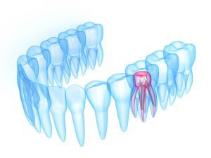 3d render of x-ray toothing with stainless steel dental post over white background. Endodontic treatment concept