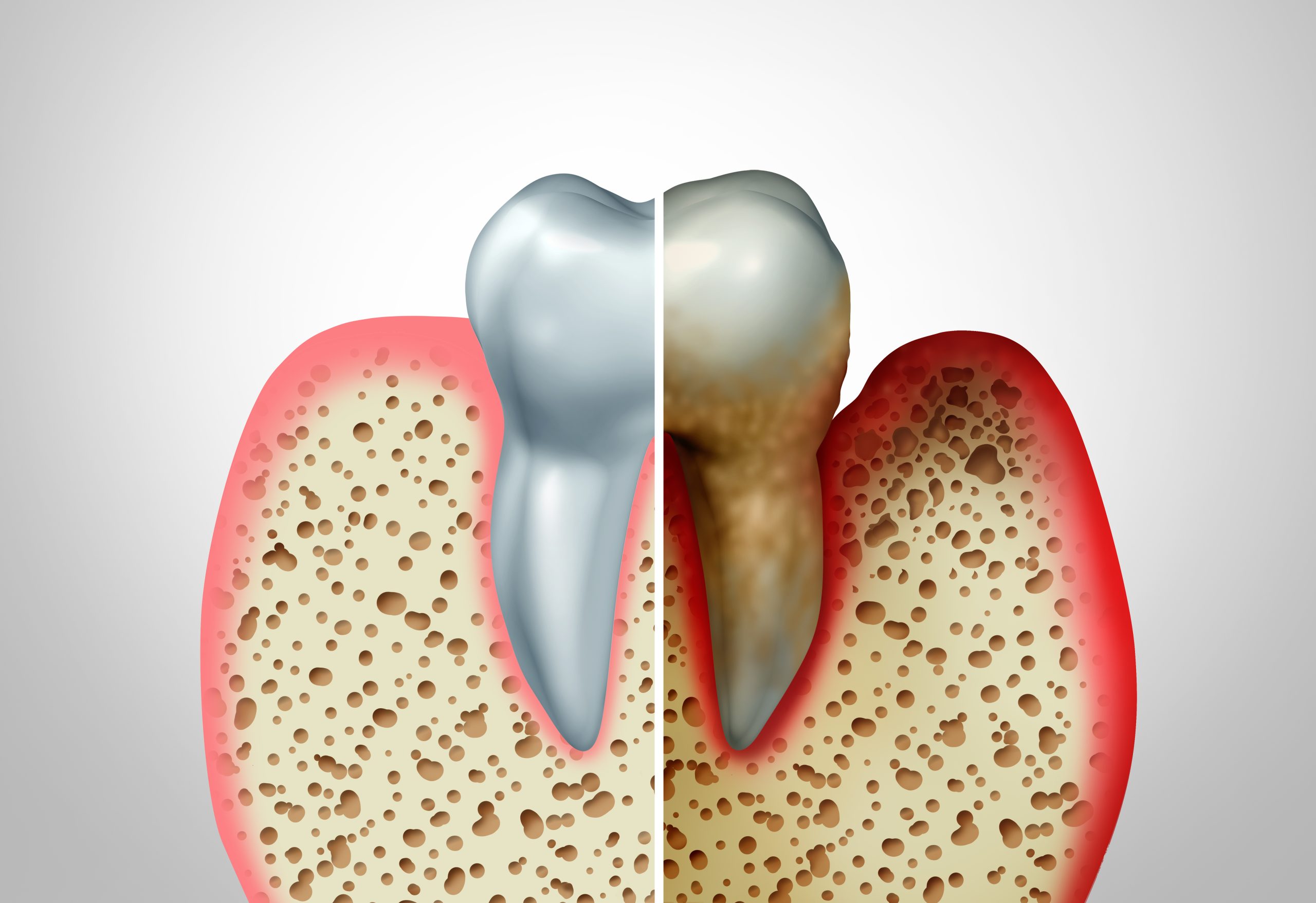 Gum disease comparison with a healthy tooth and an unhealthy one with periodontitis and poor oral hygiene health problem as a bacteria infection diagram concept with inflammation as a 3D illustration.