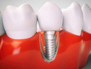 Dental implant on the example of a jaw model