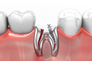 Root canal treatment process. 3d render