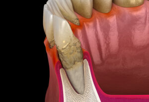 pella gum disease treatment