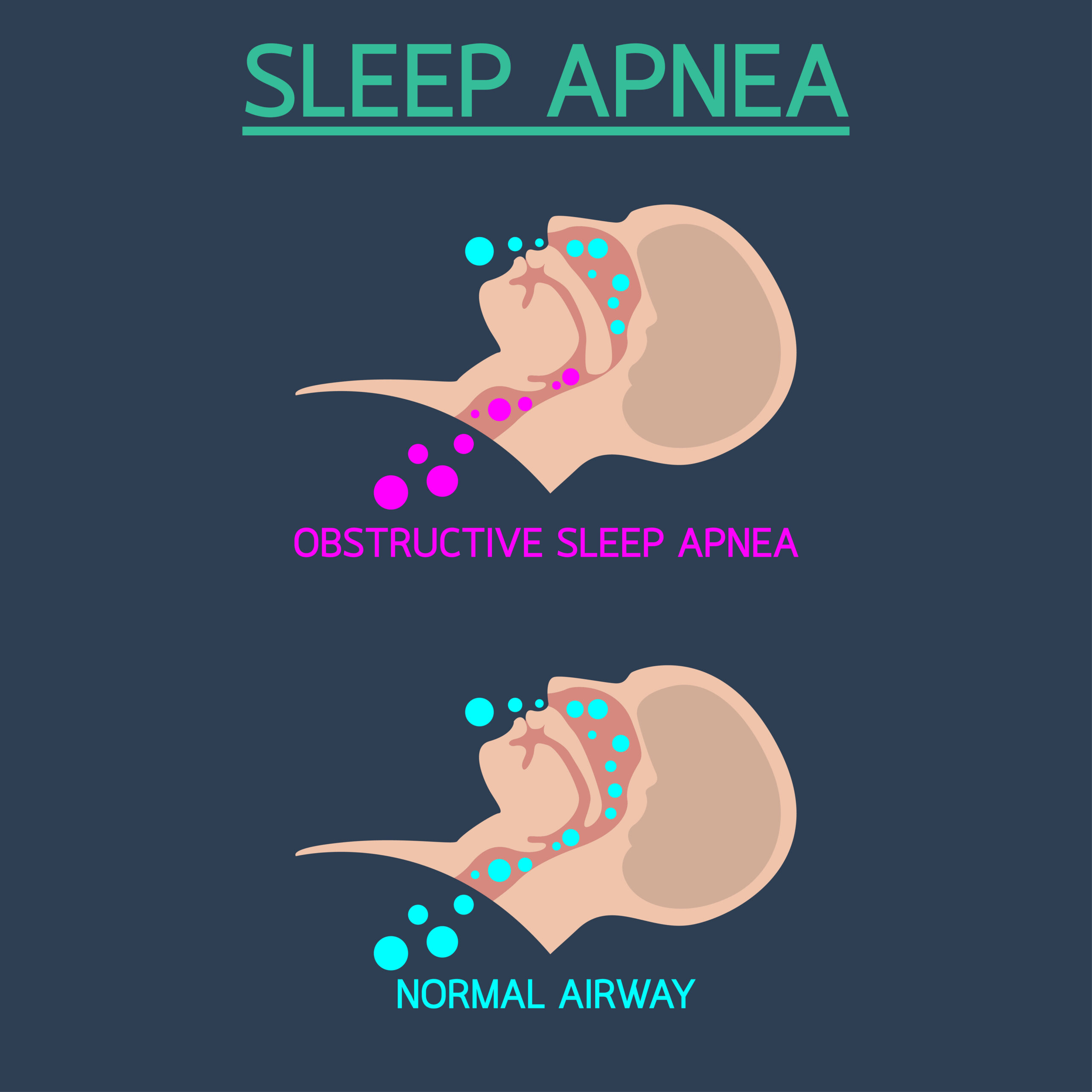 pella sleep apnea