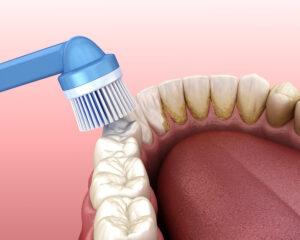 pella dental cleaning