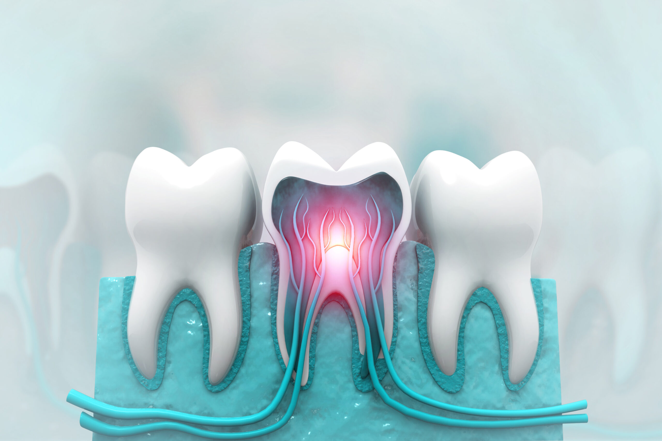 pella root canal