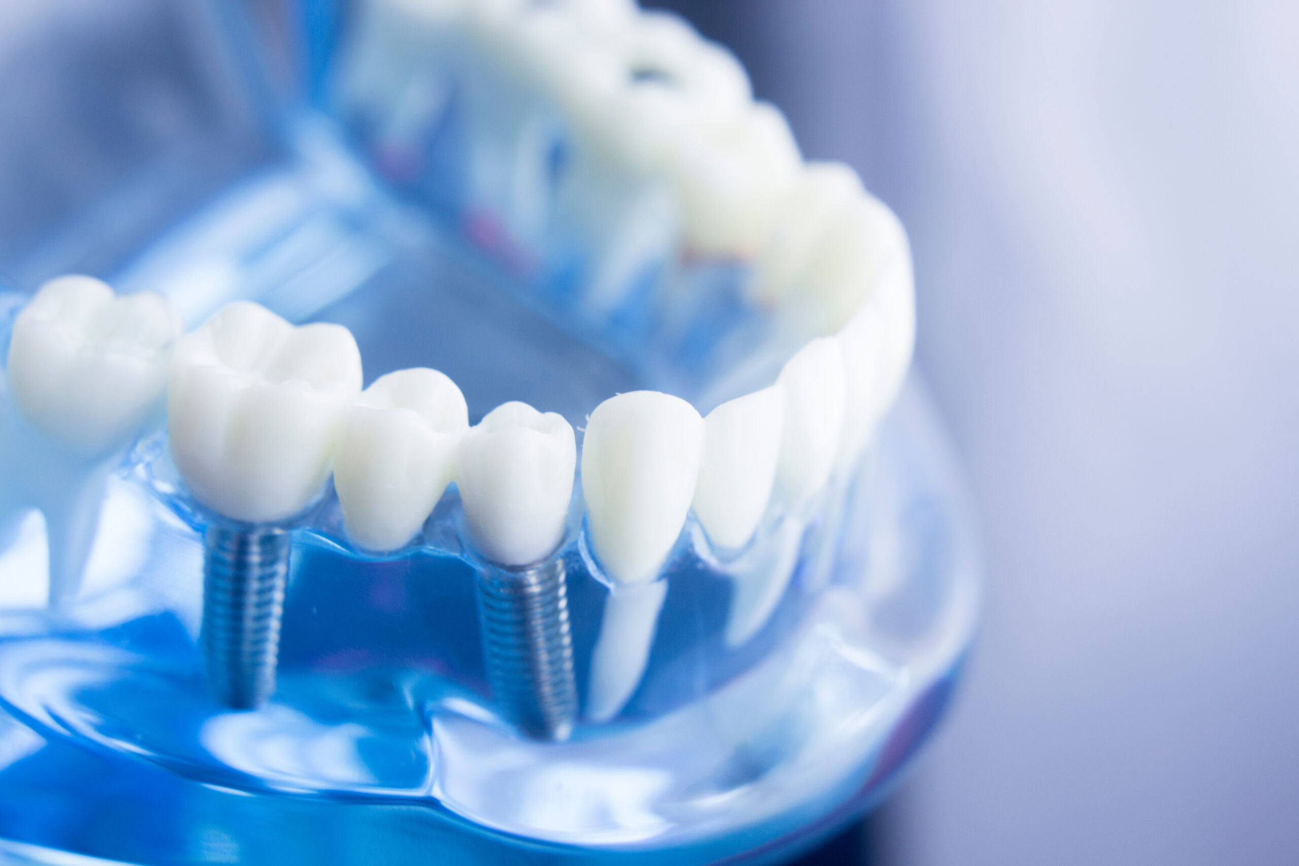 Pella, IA, dentist offers dental implants