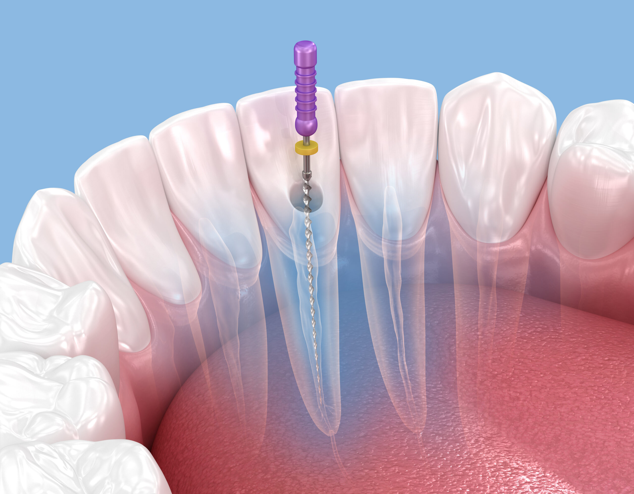 pella root canal