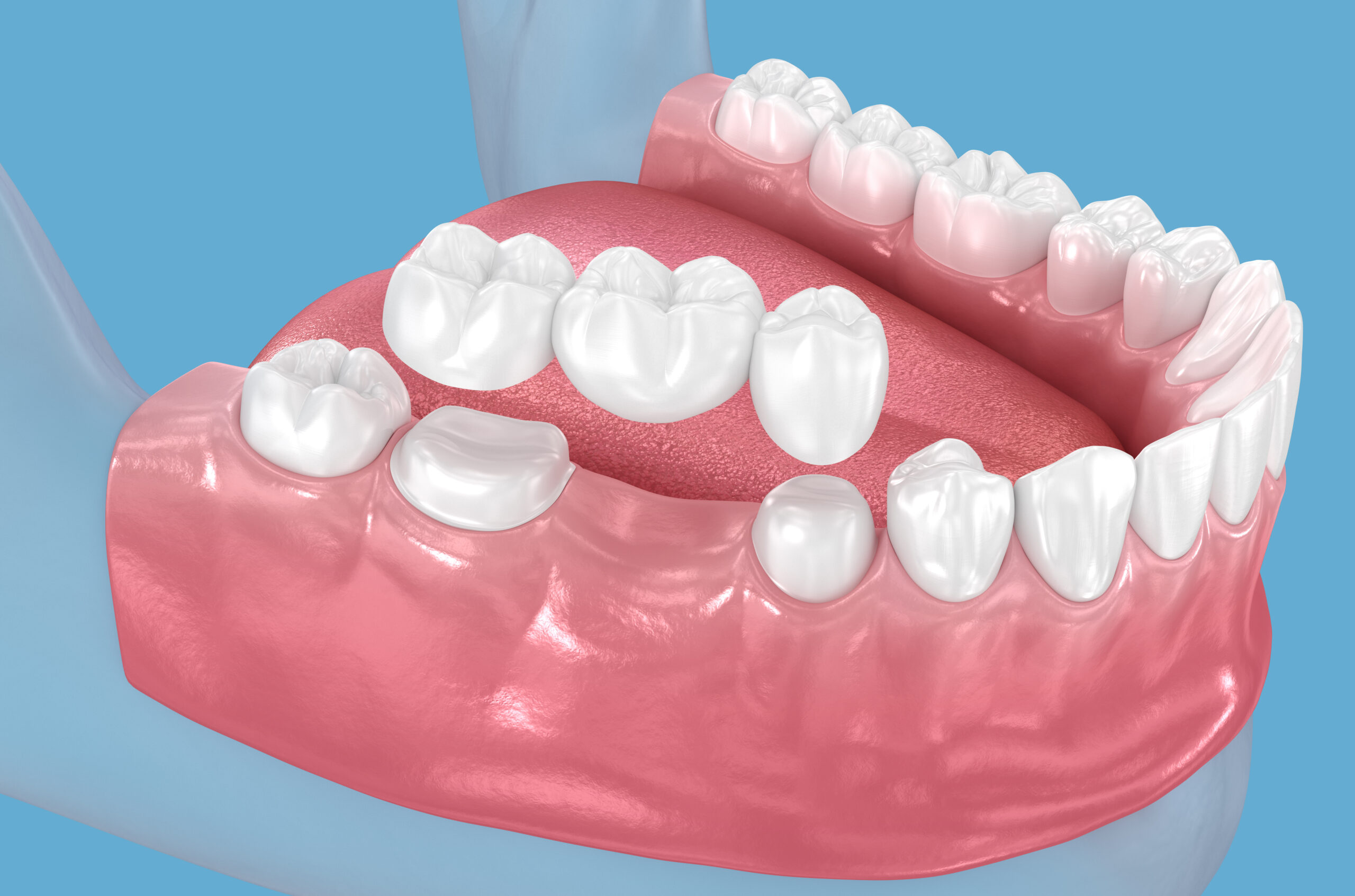 pella dental bridge