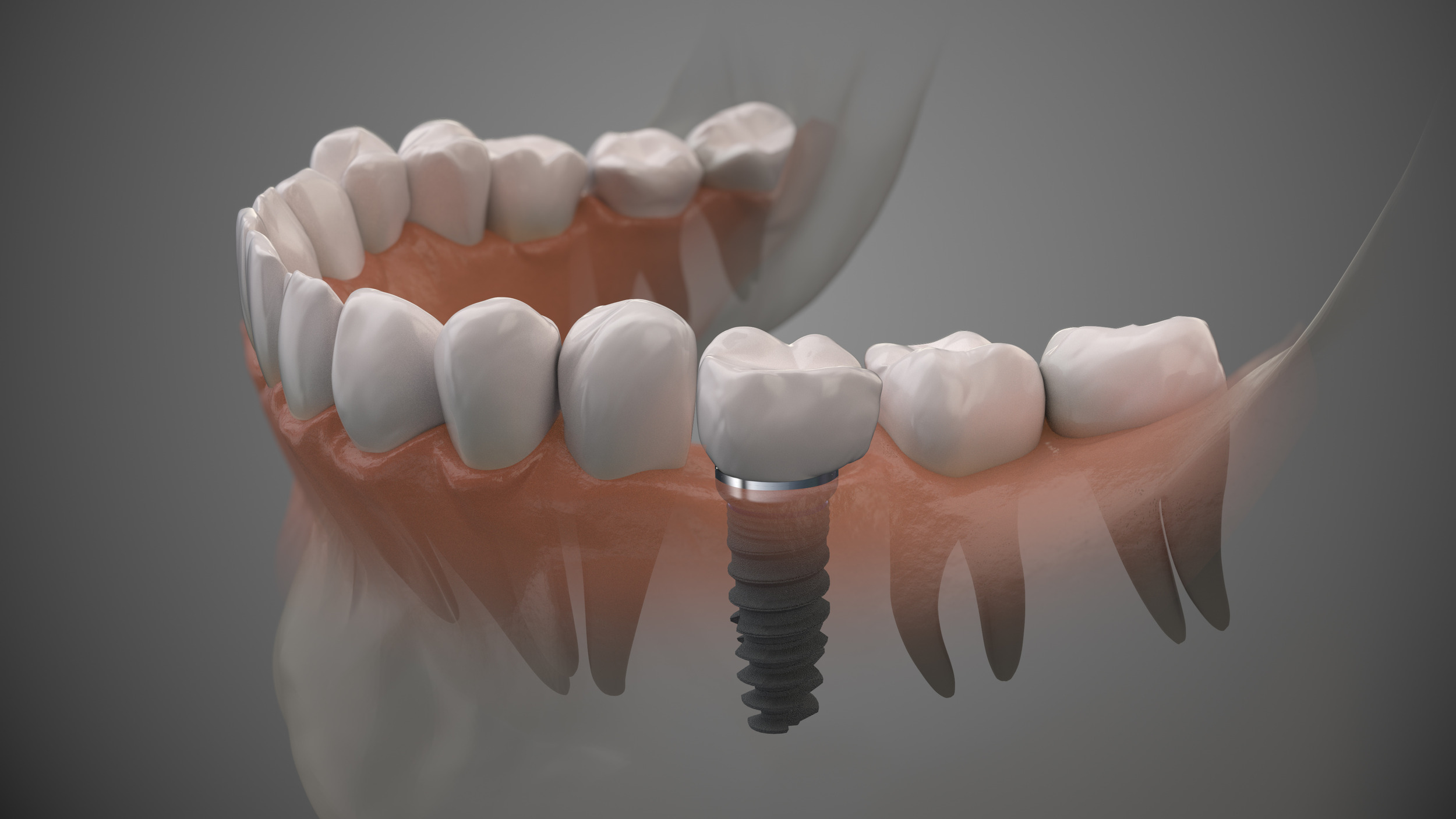 pella dental implants