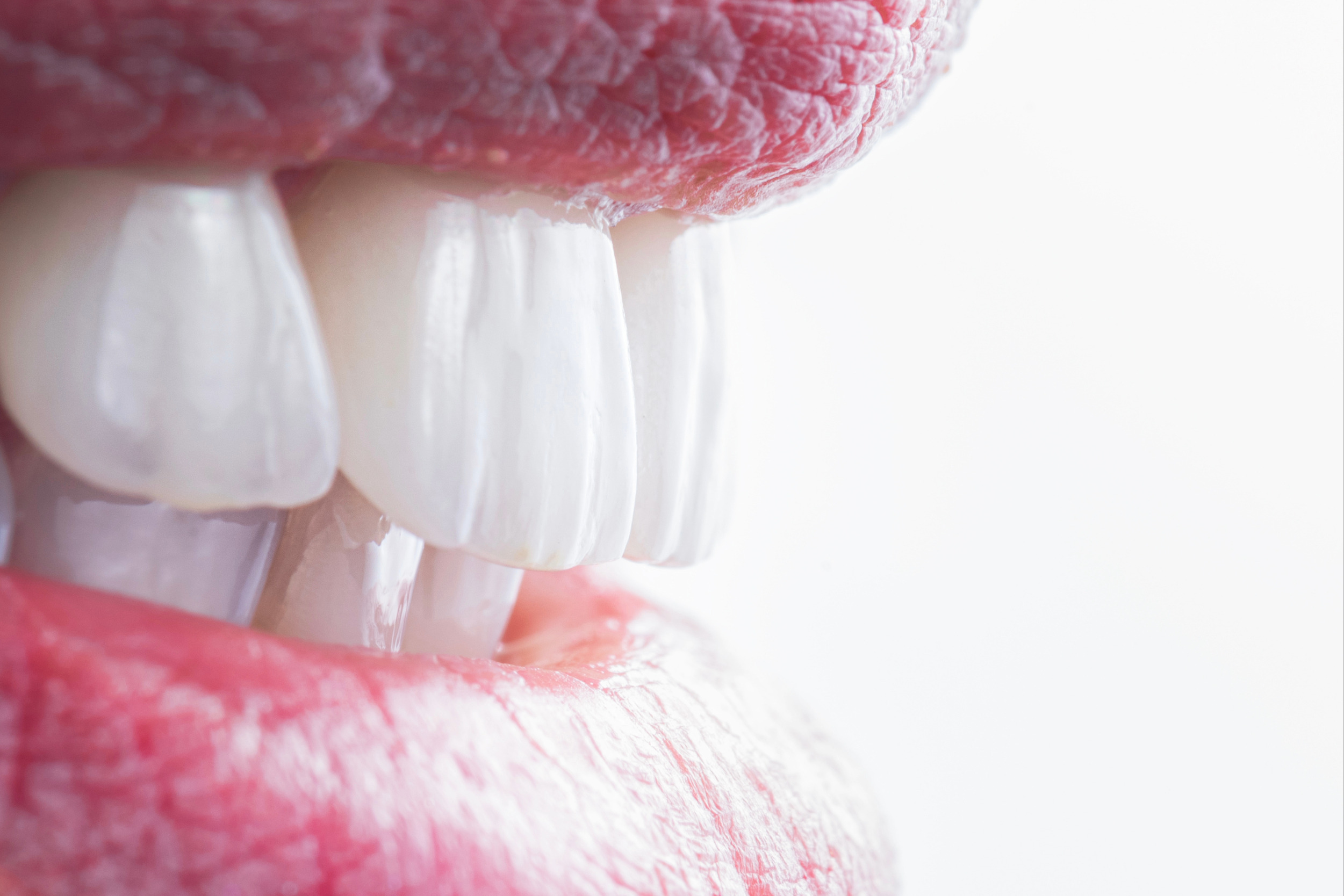 pella veneers