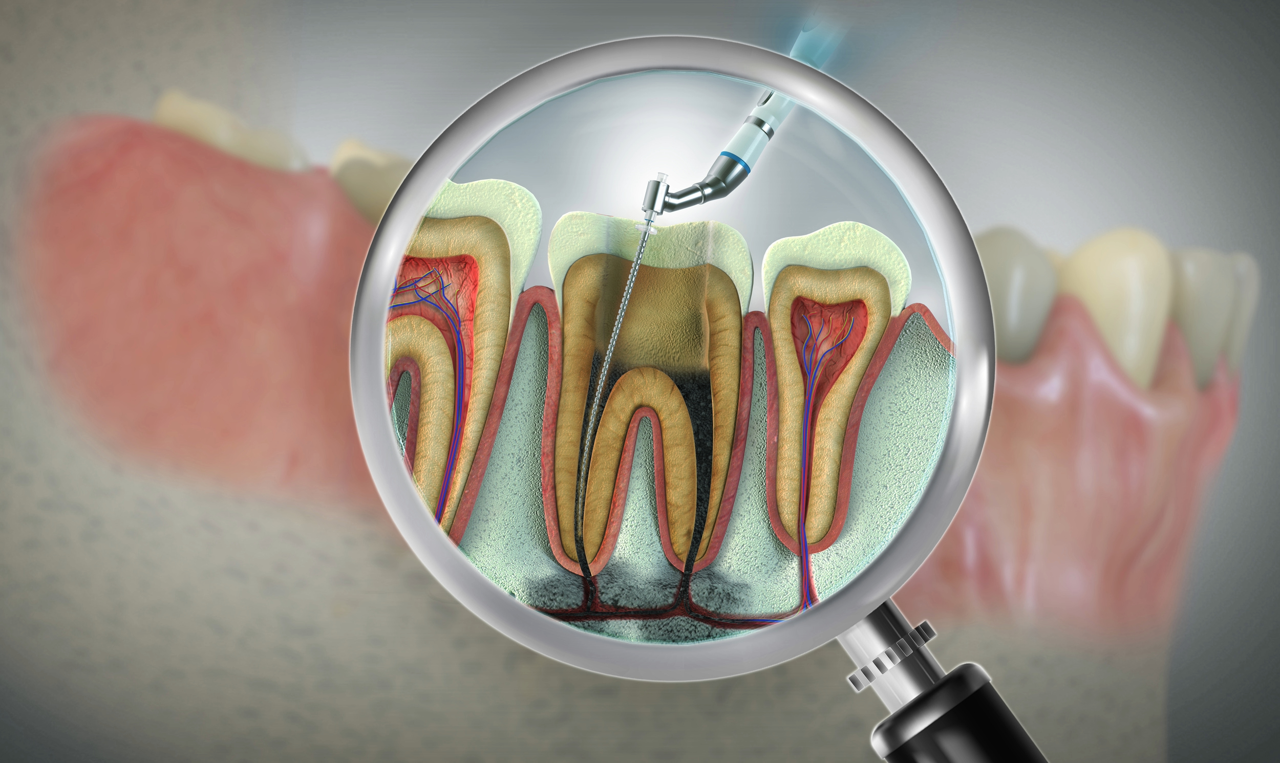 pella root canal