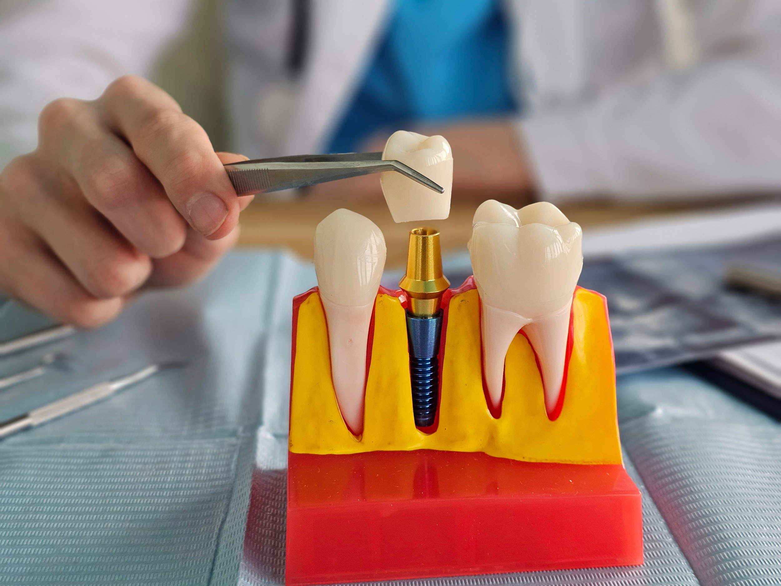 pella dental implants